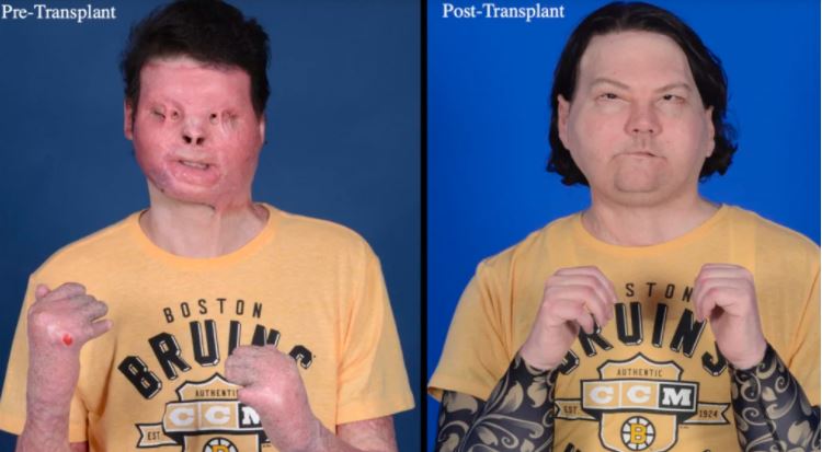 Joe Dimeo antes e depois do transplante