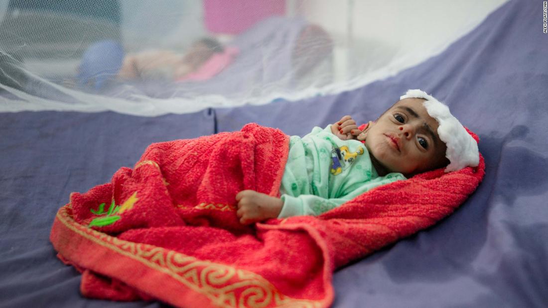 Menino em tratamento contra a fome no Iêmen
