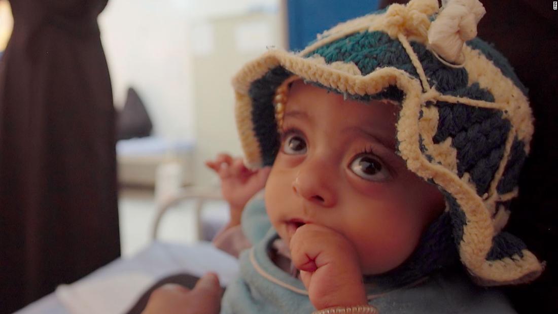 Criança em tratamento contra a desnutrição no Iêmen