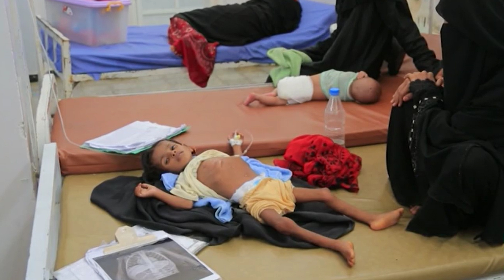 Criança em tratamento contra desnutrição no Iêmen