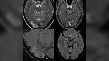 Médicos achavam que condição poderia ser causada por um tumor, mas depois verificaram que se tratava de um cisto cheio de larvas