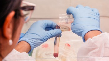 A Anvisa autorizou a realização de testes em humanos nesta terça-feira (25); terapia pode diminuir gravidade de casos da doença