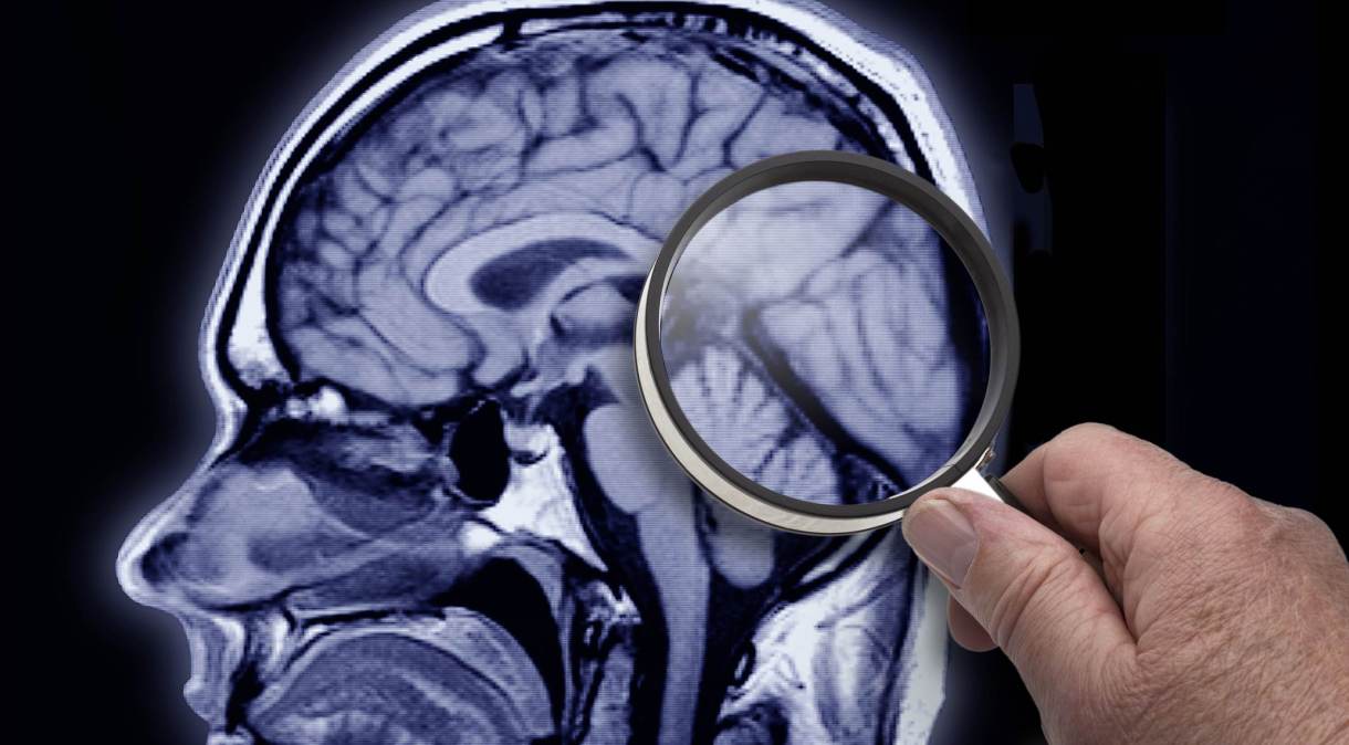 Medidas preventivas podem retardar o desenvolvimento do Alzheimer