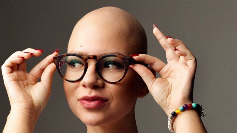 Publicitária Yasmin Martinez vive com alopecia desde os 8 anos de idade