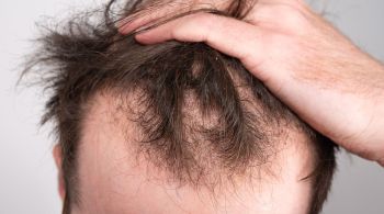 Metanálise de 23 estudos mostrou prós e contras dos melhores tratamentos; especialistas alertam que nenhum deles se aplica a mulheres com queda de cabelo