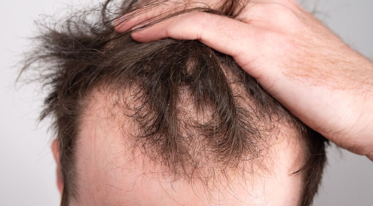Estudo analisou pesquisas sobre o impacto na queda de cabelo masculino com o uso de várias dosagens de três medicamentos orais e tópicos