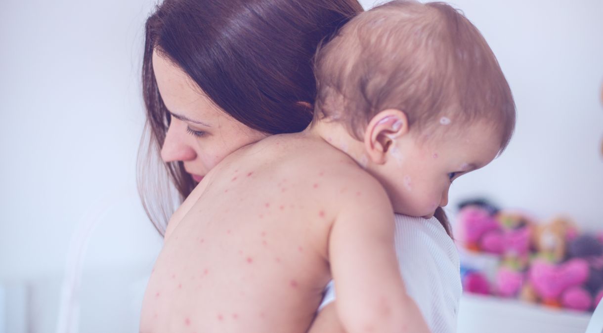 Sarampo pode trazer complicações de saúde graves em crianças não vacinadas, alerta infectologista