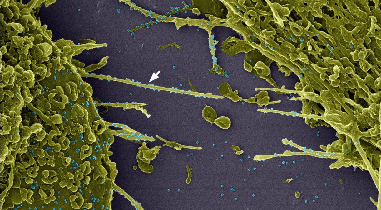 Cientistas da Fiocruz revelaram processo de infecção do SARS-CoV-2 em imagens de microscopia