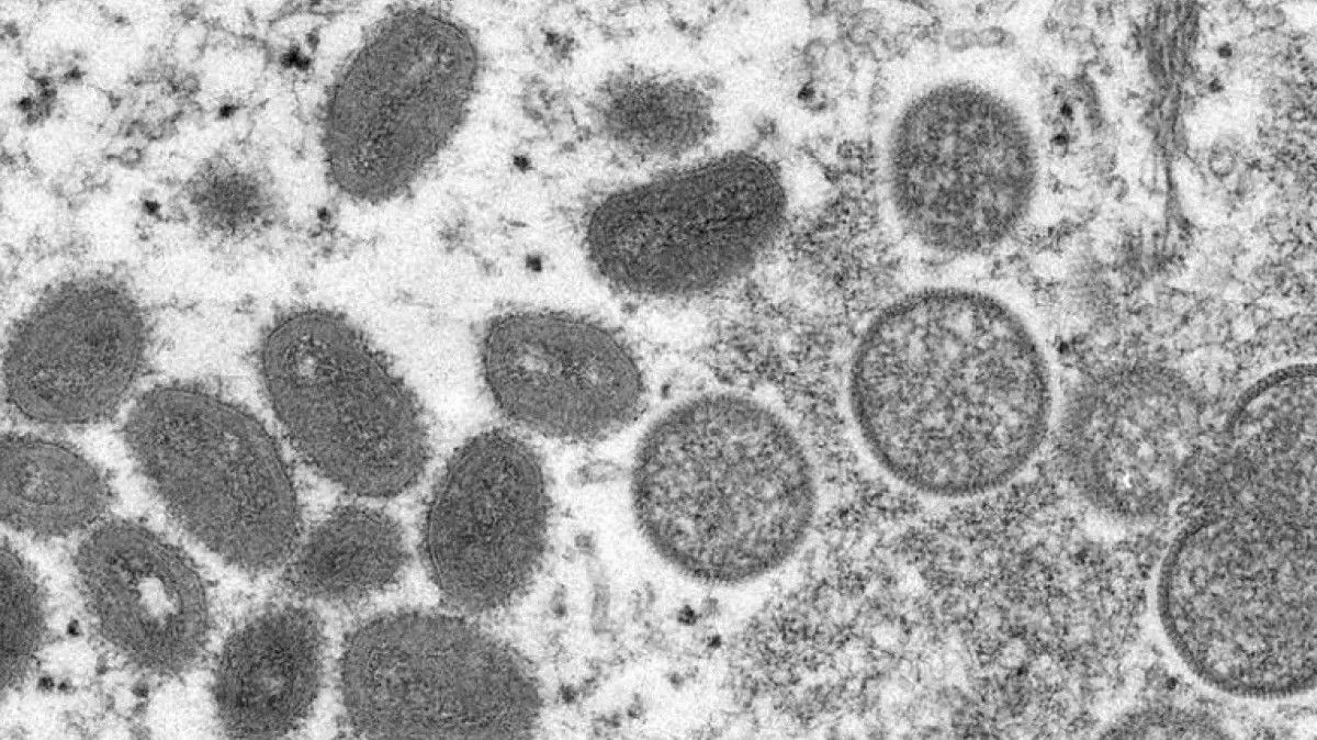 Vírus da "varíola dos macacos"