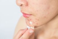 Acne, manchas e irritações: como o uso de máscara afetou a nossa pele