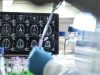 Novo medicamento para tratar Alzheimer precoce é aprovado nos EUA