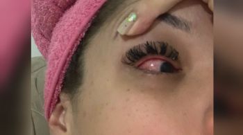 Produto pode causar irritação nos olhos; Recife registrou mais de 100 emergências oftalmológicas neste fim de semana