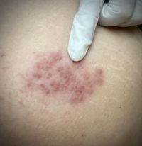 Herpes zoster: o que é, quais são os sintomas e como é feito o tratamento