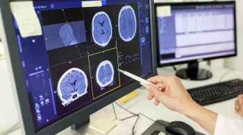 Especialistas apontam aumento de casos de abscessos cerebrais, bolsões de infecção cheios de pus que se espalham para o cérebro