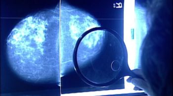 Estudo foi o primeiro a usar IA para avaliação ampla de elementos cancerígenos e não cancerígenos do câncer de mama invasivo