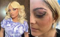 Bebe Rexha mostra rosto machucado após ser atingida por celular em show