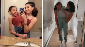 Conectadas pelo torso, Carmen e Lupita Andrade buscam normalizar a vida de gêmeas nas redes sociais; confira 