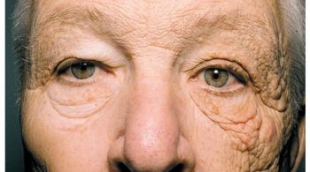 Imagem publicada no New England Jounal of Medicine mostra um homem de 69 anos que teve apenas um lado do rosto exposto à luz solar de forma constante durante boa parte de sua vida
