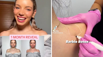 Mulheres estão aplicando botox nos ombros para alongar o pescoço; saiba os perigos deste procedimento estético