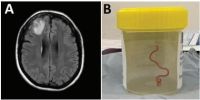 Verme comum em cobras píton é achado no cérebro humano pela 1ª vez, aponta estudo