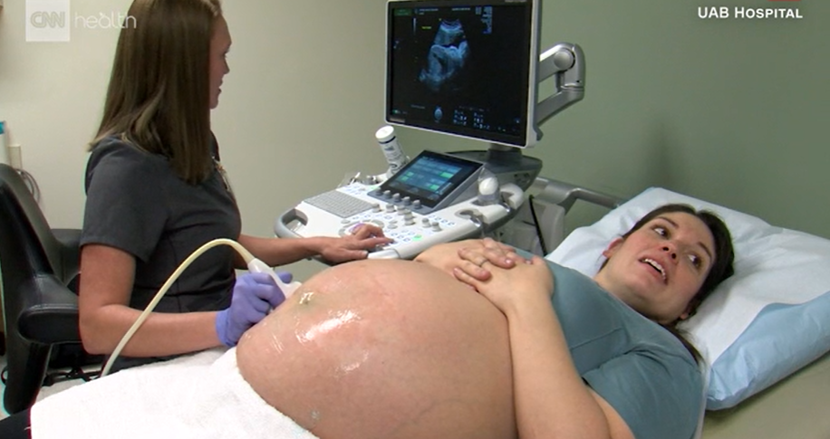 Mulher com condição genética rara está grávida de gêmeos, mas um em cada útero
