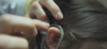 Roberto Kalil explica como funciona o implante coclear, o chamado “ouvido biônico”, cirurgia que implanta um aparelho eletrônico que substitui a função do ouvido interno nas pessoas que têm surdez total ou quase total