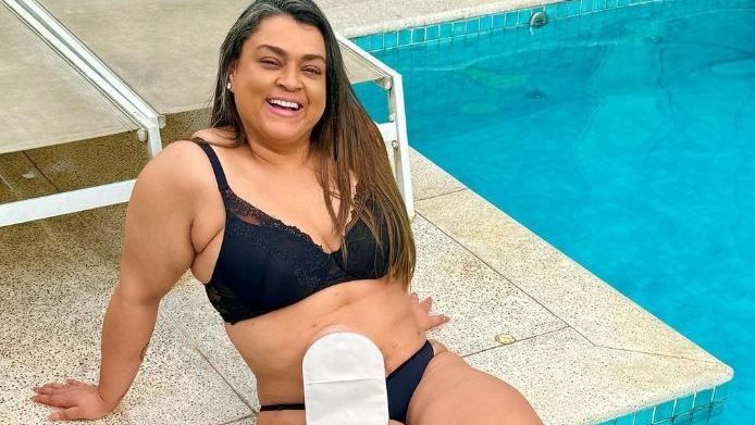 Preta Gil se despede de bolsa de ileostomia utilizada durante tratamento contra um câncer no intestino