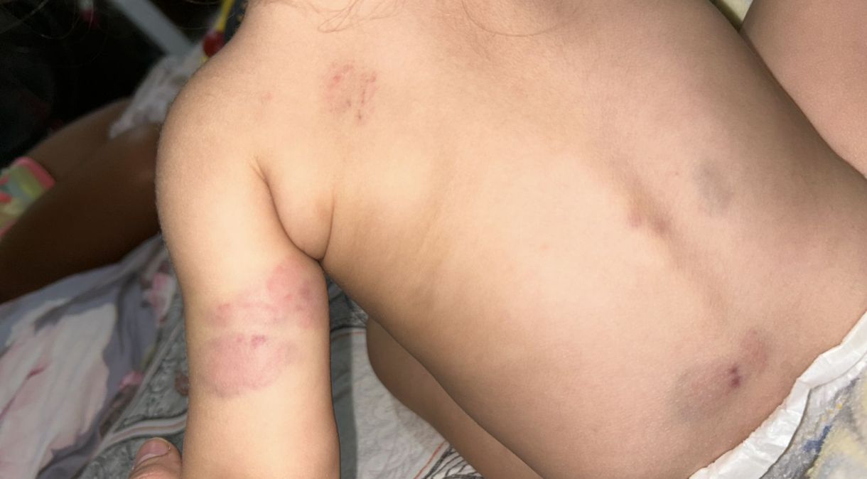 Costas do bebe que sofreu agressão em creche particular na Rocinha (RJ).