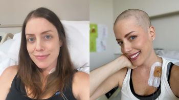 Tratando uma leucemia mieloide aguda, a influenciadora compartilhou o momento nas redes sociais