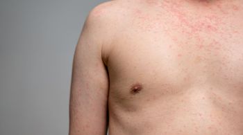 O sarampo é um vírus altamente contagioso, transmitido pelo ar, que afeta principalmente crianças com menos de cinco anos de idade