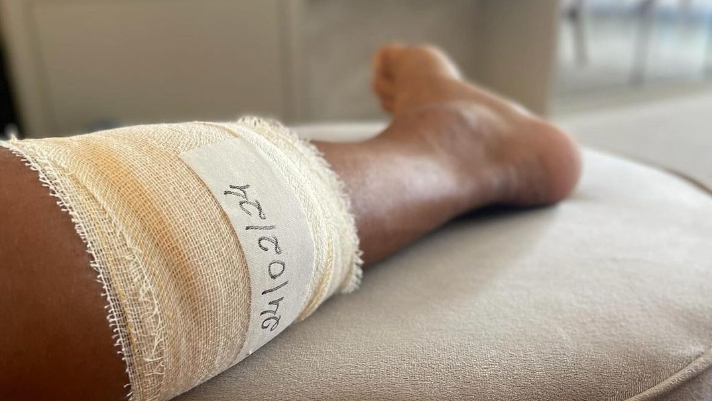 Titi postou foto após cirurgia na perna