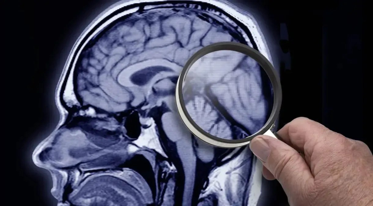 Pesquisadores identificaram vários fatores de risco para Alzheimer com a ajuda de inteligência artificial