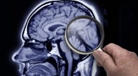 Alzheimer: IA identifica fatores de risco com 7 anos de antecedência