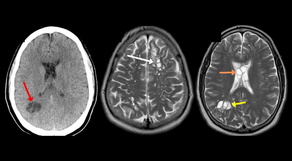 As enxaquecas de um homem foram causadas por uma infecção parasitária por tênia chamada neurocisticercose. As setas apontam para cistos larvais de tênia.