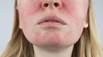 A exposição solar e a umidade, comuns diante das altas temperaturas, podem levar ao surgimento ou agravamento de doenças de pele