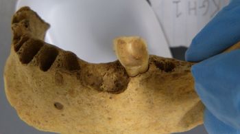 Análise das bactérias encontradas em dois dentes de um homem que viveu na Idade do Bronze ampliou conhecimento sobre cáries e outras doenças dentárias