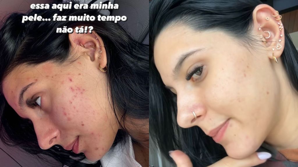 Montagem com fotos publicadas por Ana Castela mostrando antes e depois do tratamento contra acne