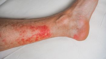 A doença é caracterizada por uma inflamação que atinge a pele dos membros inferiores, principalmente, e é causada por uma bactéria