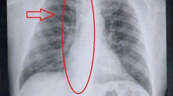 Homem teve fio-guia esquecido entre jugular e átrio do coração após cirurgia em São Vicente