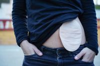 Bolsa de colostomia: o que é, para que serve e cuidados