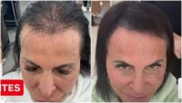 Com alopecia, Gretchen mostra cabelo mais forte após tratamento